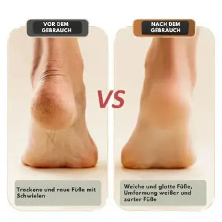 Maliben | Mivoza Electric Callus Remover — Free Your Feet And Enjoy Silky Smooth Lightness With Every Step!