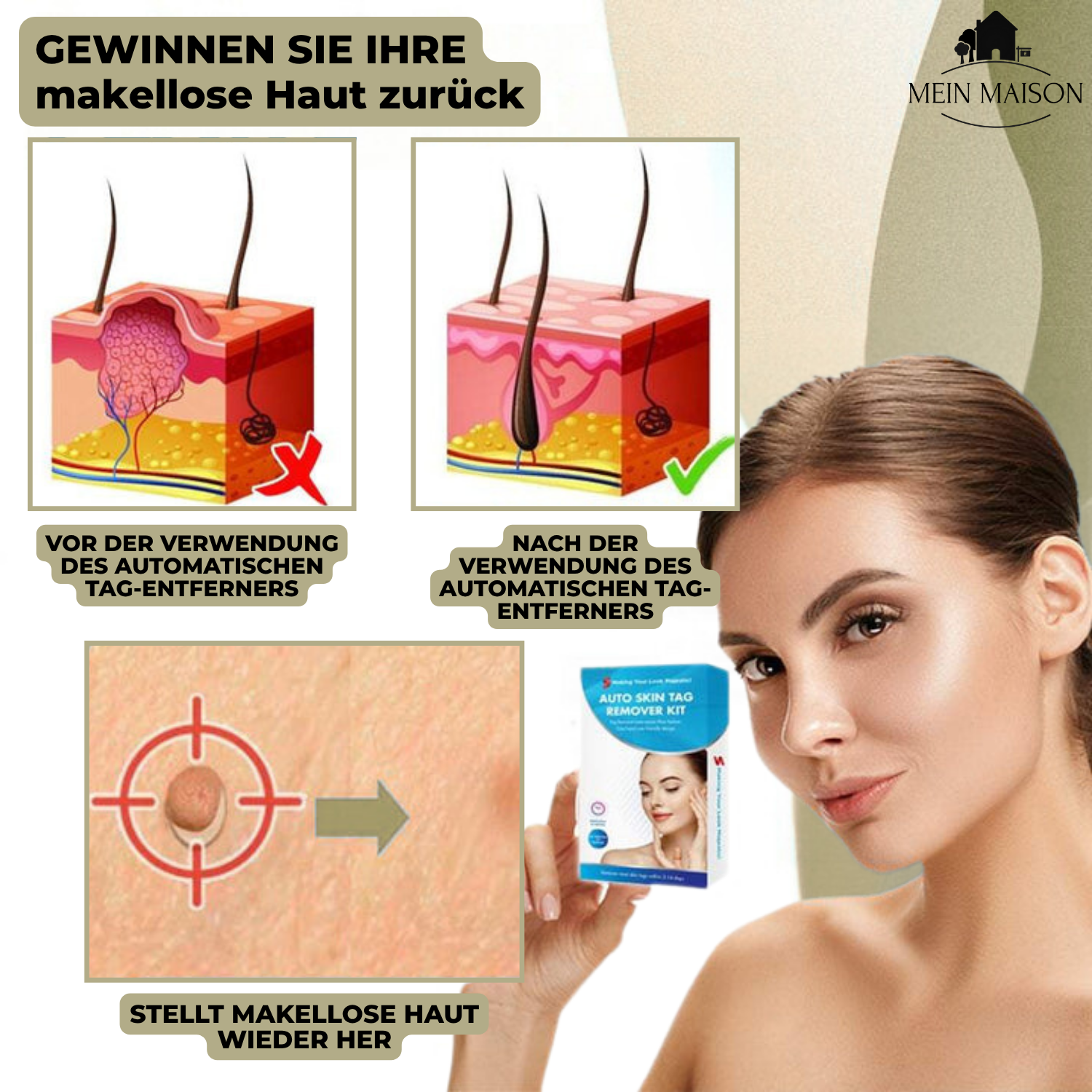 Maliben | Dermalinx Wart Remover | Pain-Free Removal Of Warts & Moles | For Home | Without Surgery
