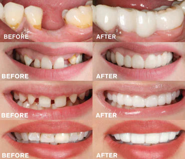 Maliben | - Snap-In Dental Prosthesis | 1+1 Free!