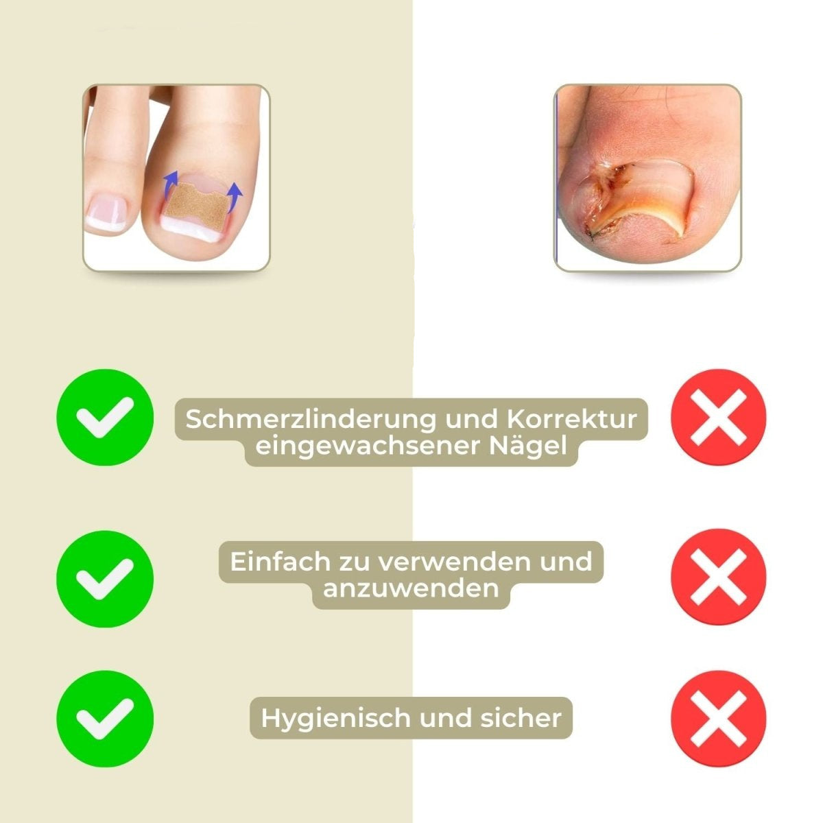 Maliben | Alignstrip – Painless Nail Correction Strips For Ingrown & Deformed Nails