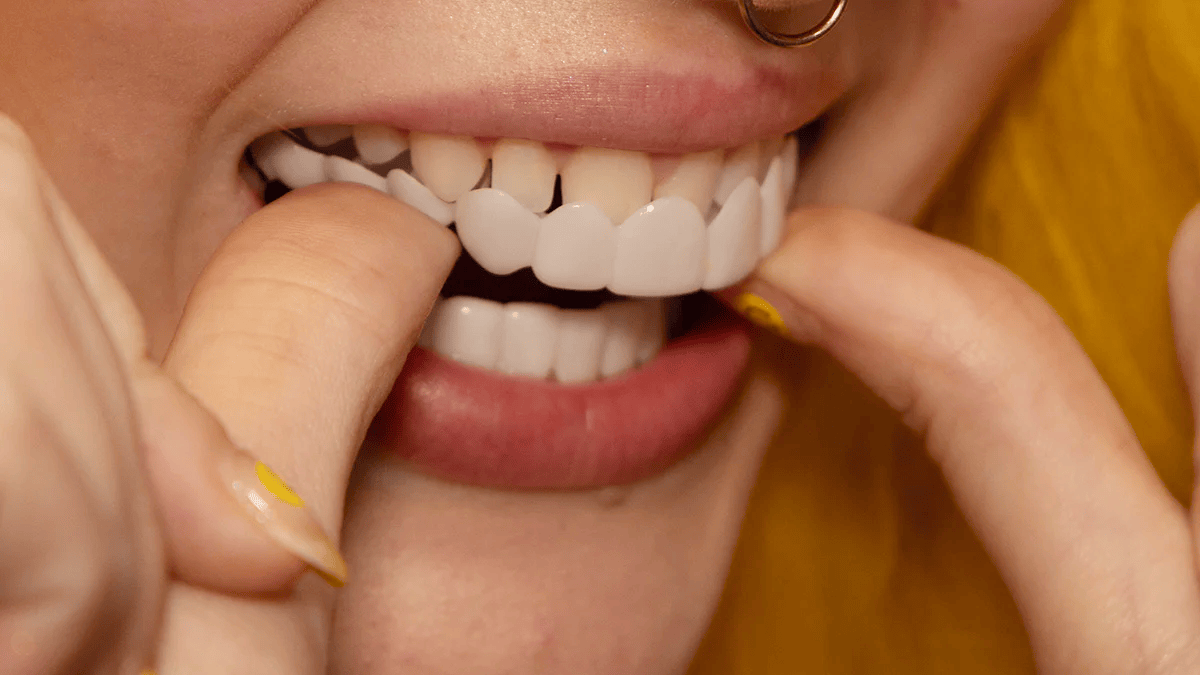 Maliben | Instant Smile TransformatiOn With Snap on Smile Veneers