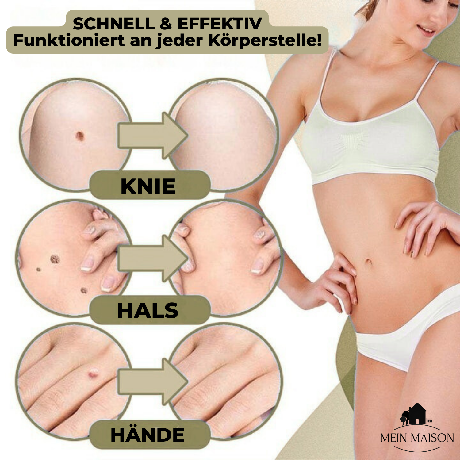 Maliben | Dermalinx Wart Remover | Pain-Free Removal Of Warts & Moles | For Home | Without Surgery