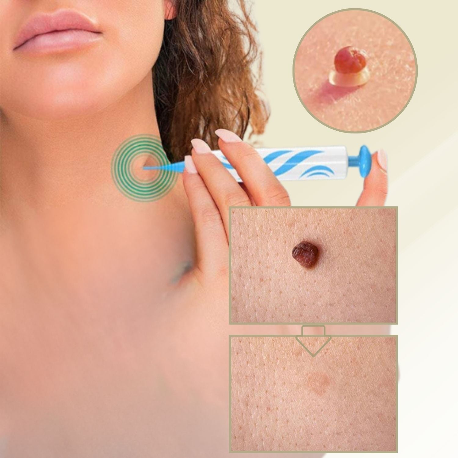 Maliben | Dermalinx Wart Remover | Pain-Free Removal Of Warts & Moles | For Home | Without Surgery