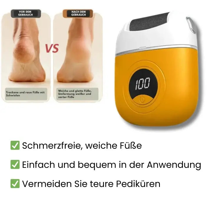 Maliben | Mivoza Electric Callus Remover — Free Your Feet And Enjoy Silky Smooth Lightness With Every Step!