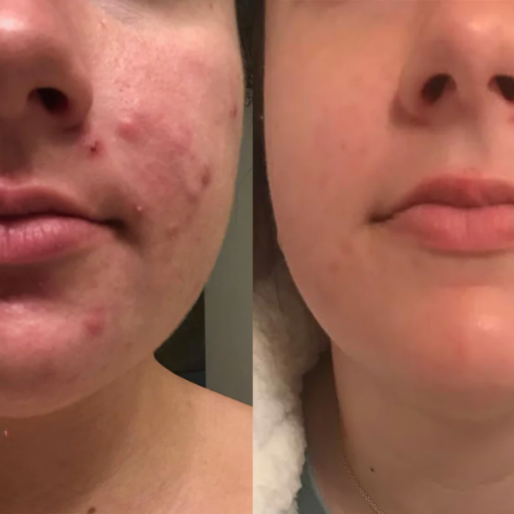 Maliben | Lumeniskin — Put An End To Blemishes And Radiate Confidence!