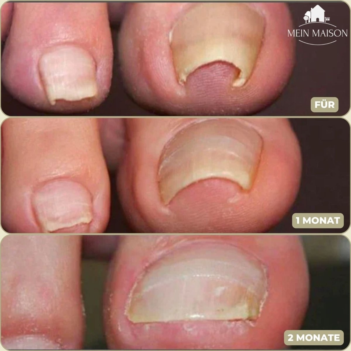 Maliben | Alignstrip – Painless Nail Correction Strips For Ingrown & Deformed Nails