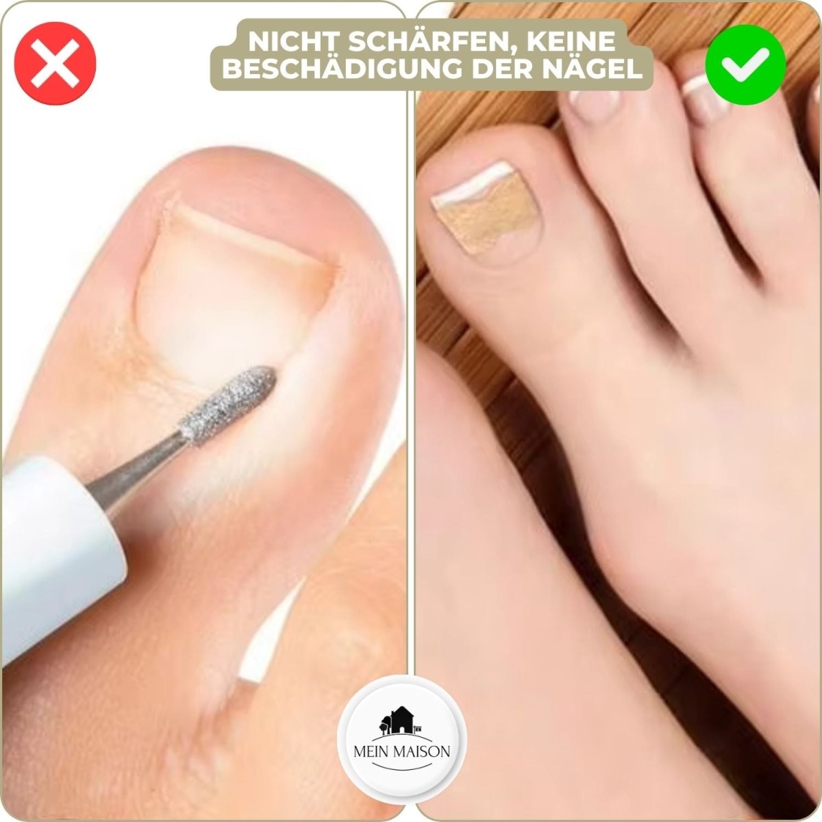 Maliben | Alignstrip – Painless Nail Correction Strips For Ingrown & Deformed Nails