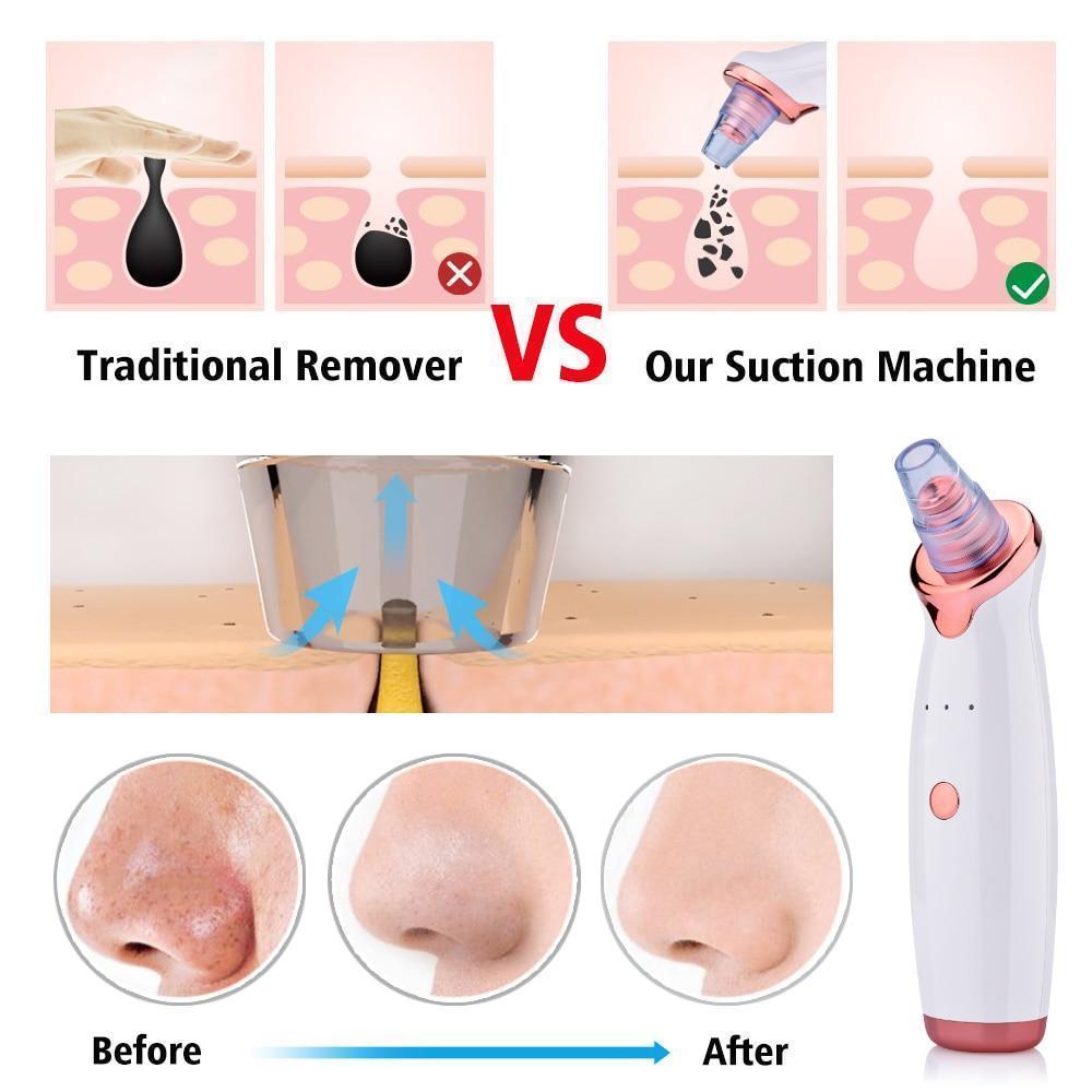 Maliben | Power Suction Blackhead Cleaner